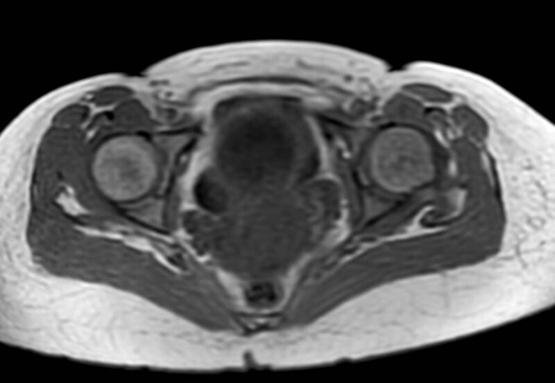 File:Appendicitis in gravida (MRI) (Radiopaedia 89433-106395 Axial T1 in-phase 66).jpg