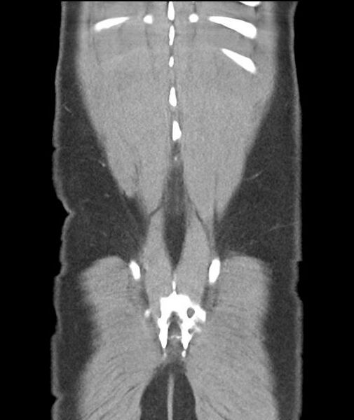 File:Appendicitis with cecal bar sign (Radiopaedia 31878-32830 A 55).jpg