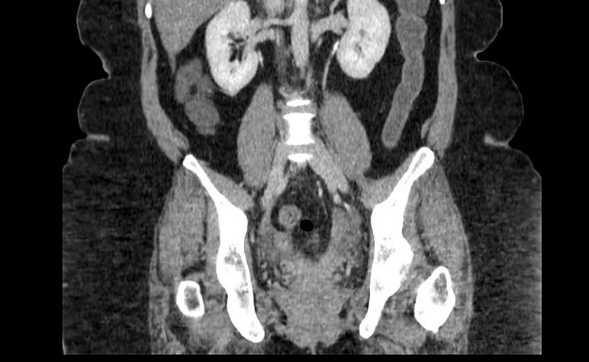 Appendix mucocele (Radiopaedia 41222-44033 B 55).jpg
