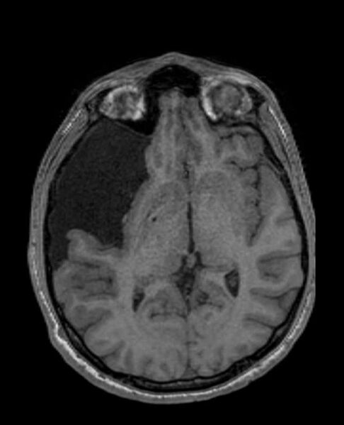 File:Arachnoid cyst- extremely large (Radiopaedia 68741-78451 Axial T1 37).jpg