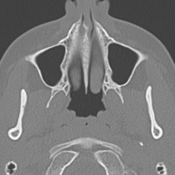 File:Arrested pneumatization of the sphenoid (Radiopaedia 10700-11172 Axial non-contrast 18).jpg