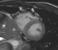 Arrhythmogenic right ventricular cardiomyopathy (Radiopaedia 39806-42237 F 15).jpg