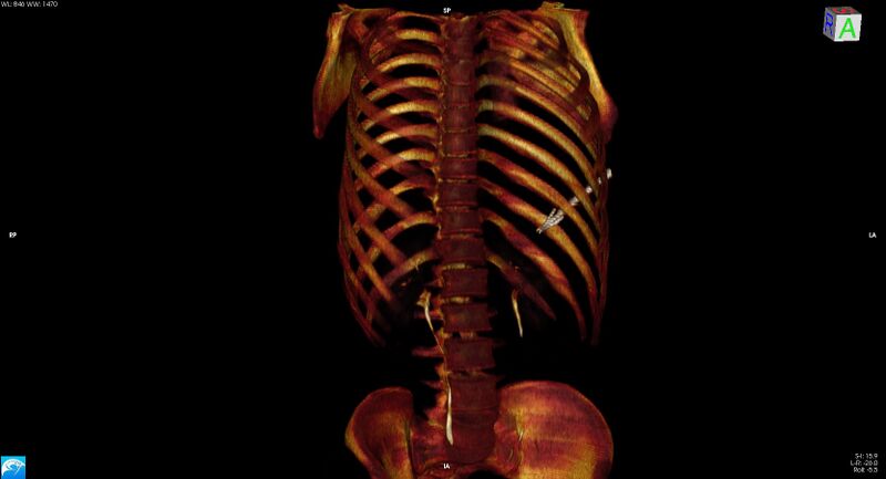 File:Arrow injury to the chest (Radiopaedia 75223-86321 3D bone 40).jpg