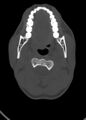 Arrow injury to the head (Radiopaedia 75266-86388 Axial bone window 29).jpg