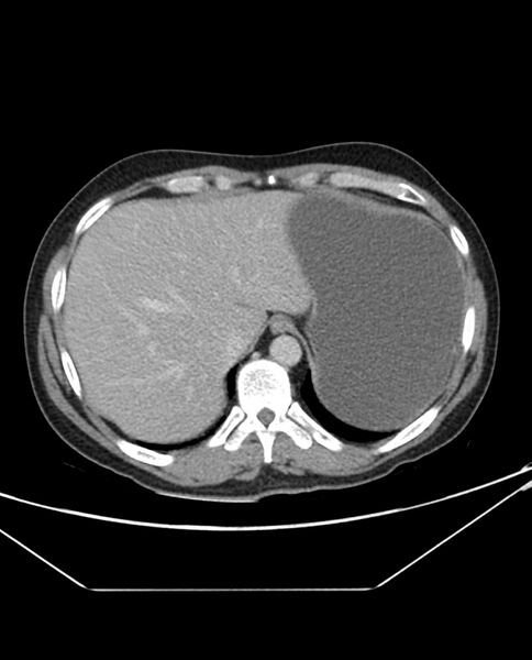File:Arterial occlusive mesenteric ischemia (Radiopaedia 84641-100054 A 18).jpg