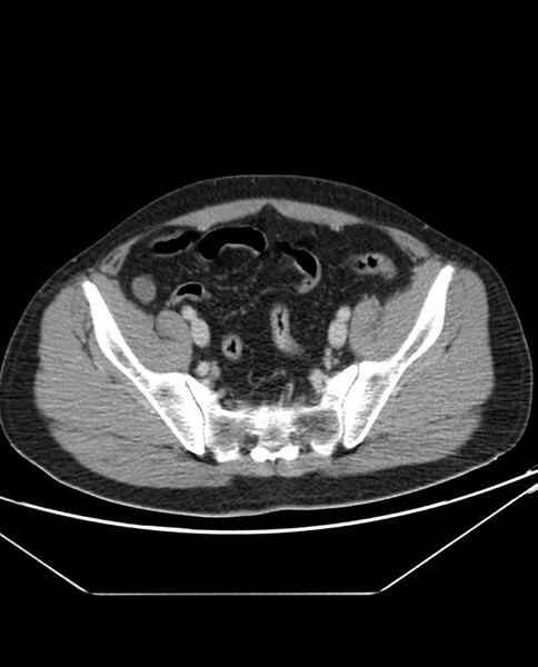 File:Arterial occlusive mesenteric ischemia (Radiopaedia 84641-100054 A 97).jpg