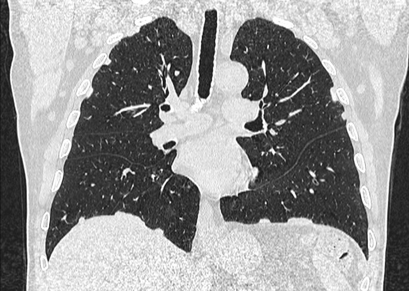 File:Asbestos pleural placques (Radiopaedia 57905-64872 Coronal lung window 148).jpg