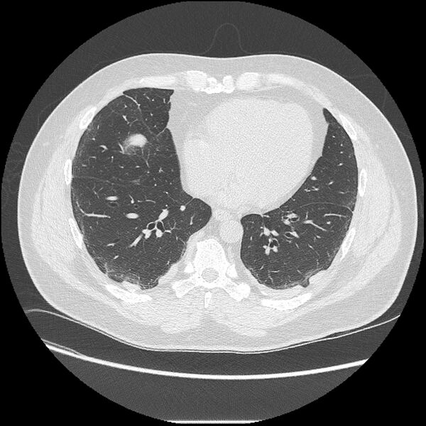 File:Asbestosis (Radiopaedia 45002-48961 Axial lung window 33).jpg