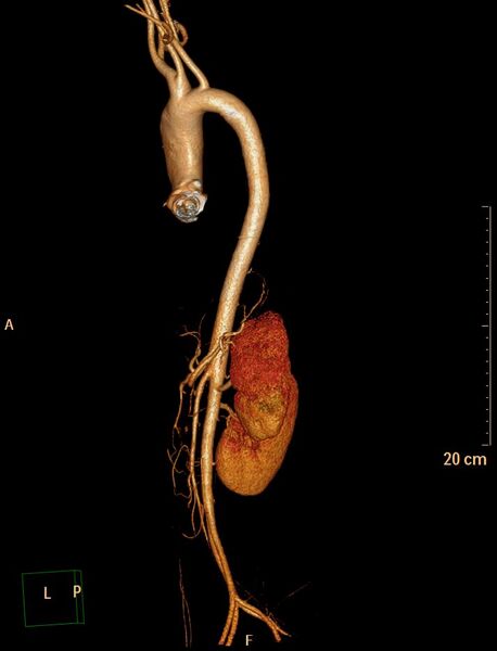 File:Ascending aortic pseudoaneurysm (Radiopaedia 28638-28910 D 25).jpg