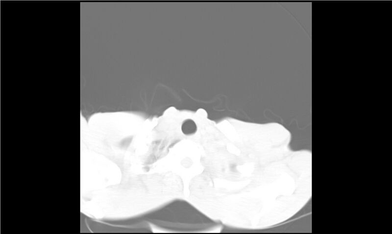 File:Aspergilloma (Radiopaedia 20788-20701 Axial lung window 2).jpg