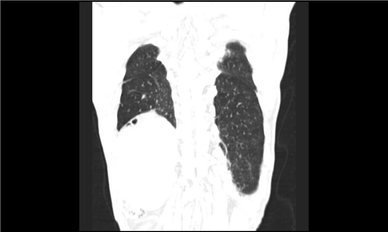 File:Aspergilloma (Radiopaedia 20788-20701 Coronal lung window 16).jpg