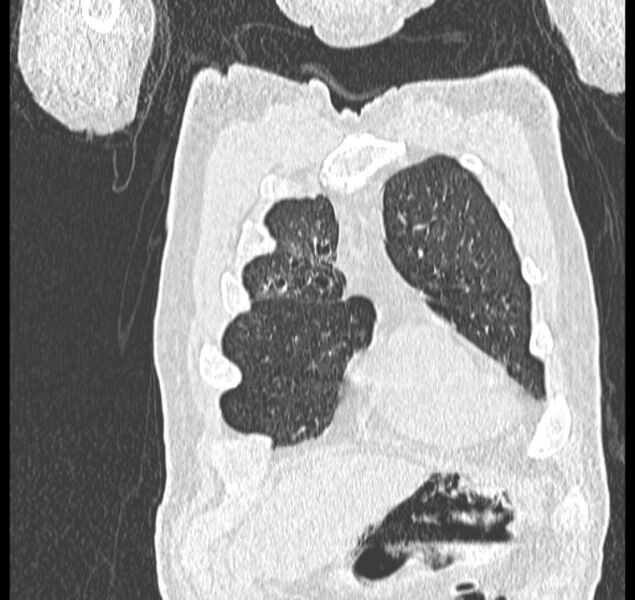 File:Aspergilloma (Radiopaedia 44592-48327 Coronal lung window 10).jpg