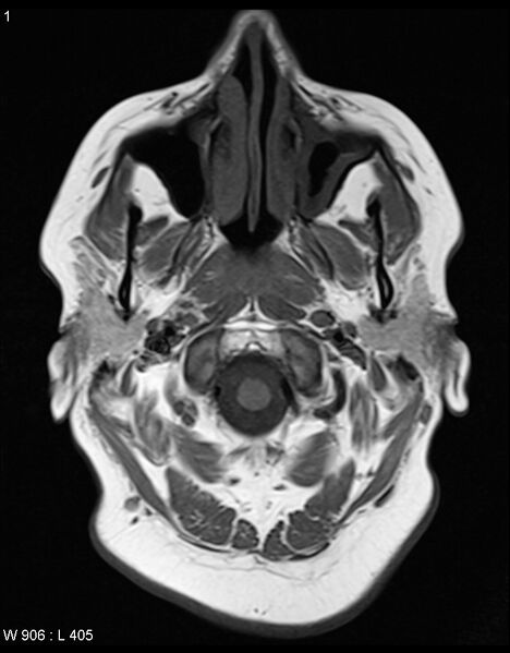 File:Astroblastoma (Radiopaedia 39792-42217 Axial T1 19).jpg