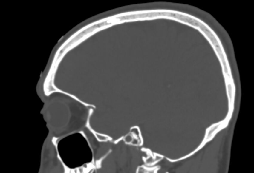Asymptomatic occipital spur (Radiopaedia 87753-104201 Sagittal bone window 212).jpg