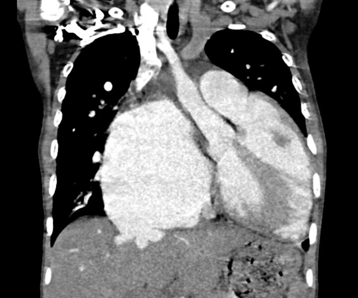 File:Atrial septal defect complicated by Eisenmenger syndrome (Radiopaedia 53707-59768 Coronal C+ CTPA 10).jpg