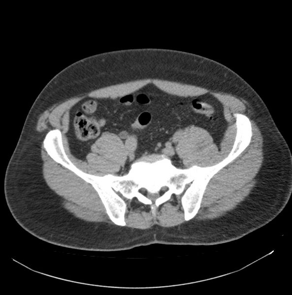 File:Atrophic kidney due to severe chronic obstructive hydronephrosis (Radiopaedia 40828-43474 Axial non-contrast 30).jpg