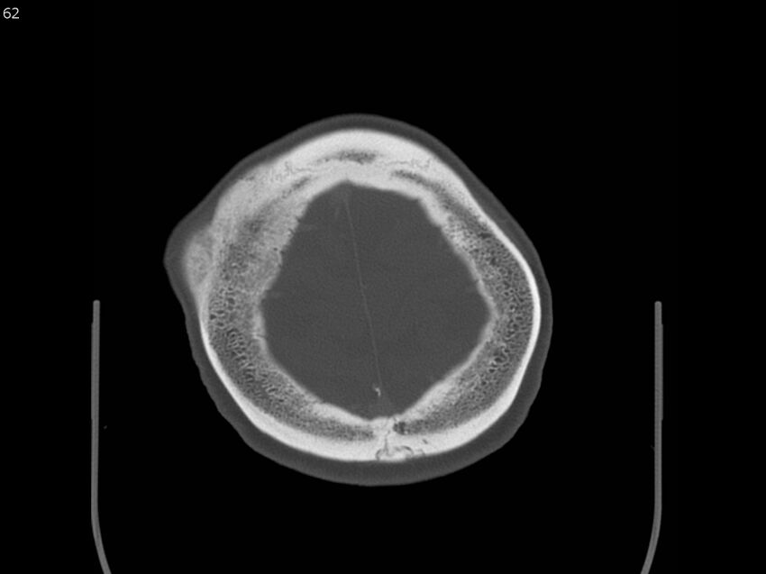 Atypical meningioma - intraosseous (Radiopaedia 64915-73867 Axial C+ bone window 62).jpg