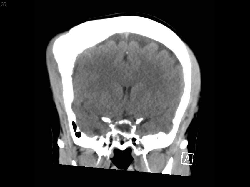 Atypical meningioma - intraosseous (Radiopaedia 64915-73867 B 32).jpg