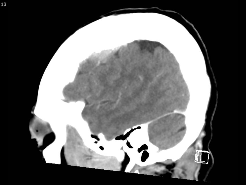 Atypical meningioma - intraosseous (Radiopaedia 64915-73867 F 17).jpg