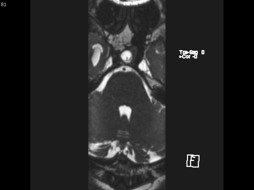 Atypical meningioma - intraosseous (Radiopaedia 64915-74572 Axial CISS 81).jpg