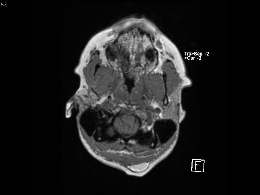 Atypical meningioma - intraosseous (Radiopaedia 64915-74572 Axial T1 53).jpg