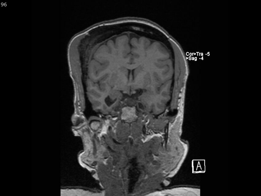 Atypical meningioma - intraosseous (Radiopaedia 64915-74572 Coronal T1 96).jpg