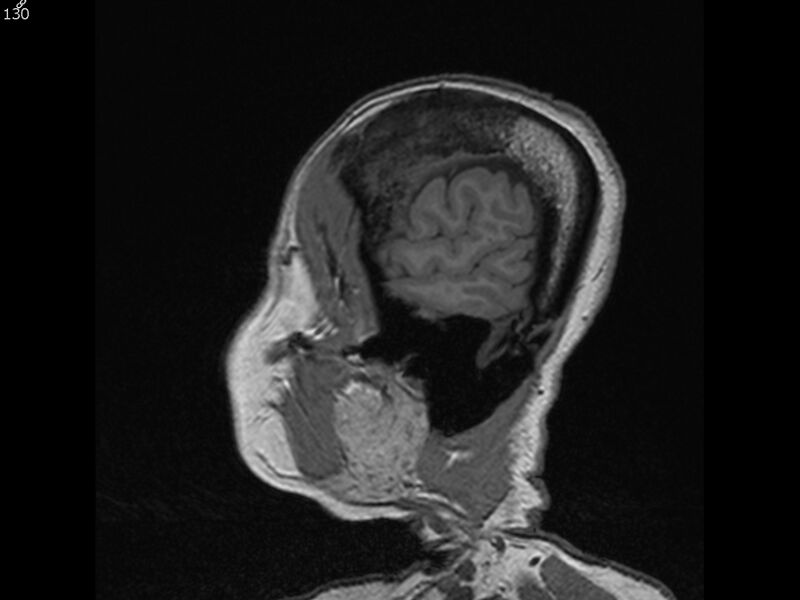 File:Atypical meningioma - intraosseous (Radiopaedia 64915-74572 Sagittal T1 130).jpg