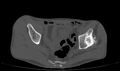 Avascular necrosis of the left hip (Radiopaedia 75068-86125 Axial bone window 14).jpg