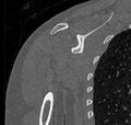 Avulsion fracture - greater tuberosity of humerus (Radiopaedia 71216-81514 Coronal bone window 44).jpg