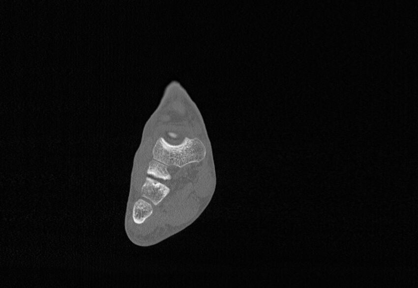 Avulsion fractures of talus and calcaneus (Radiopaedia 48277-53155 Coronal bone window 35).jpg