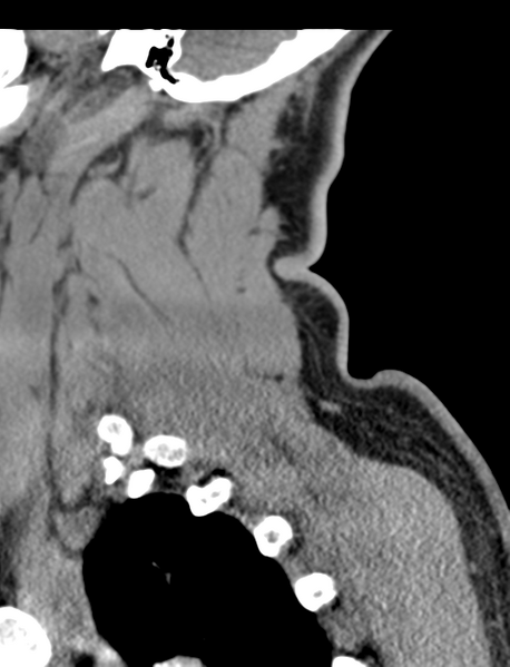 File:Axis peg fracture (type 3) and atlas lateral mass (type 4) fracture (Radiopaedia 37474-39324 D 63).png
