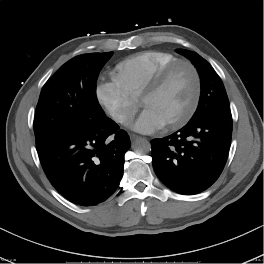 Azygos venous system anatomy (CT pulmonary angiography) (Radiopaedia 25928-26077 Axial C+ CTPA 59).jpg