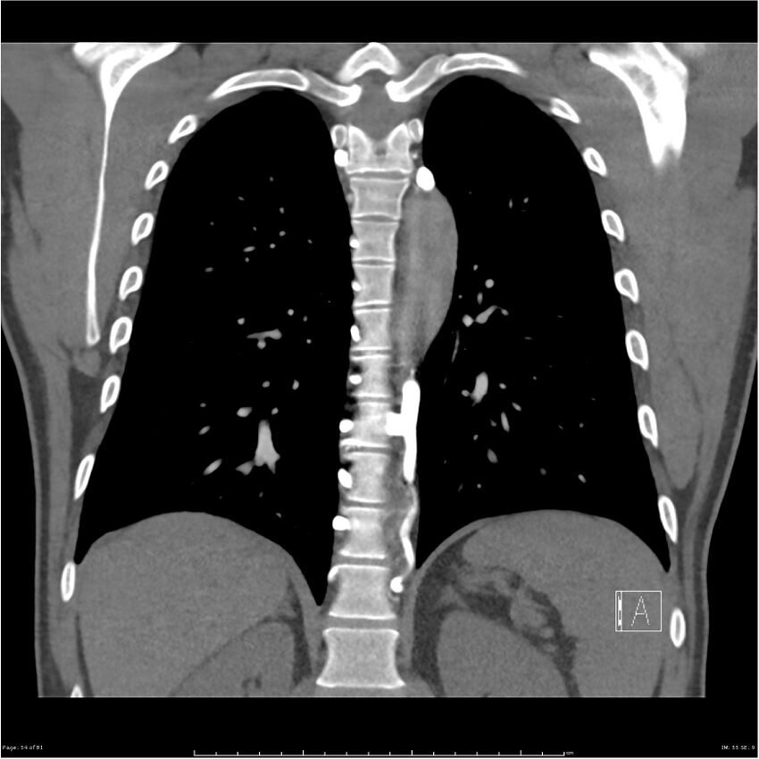 Azygos venous system anatomy (CT pulmonary angiography) (Radiopaedia 25928-26077 Coronal C+ CTPA 54).jpg