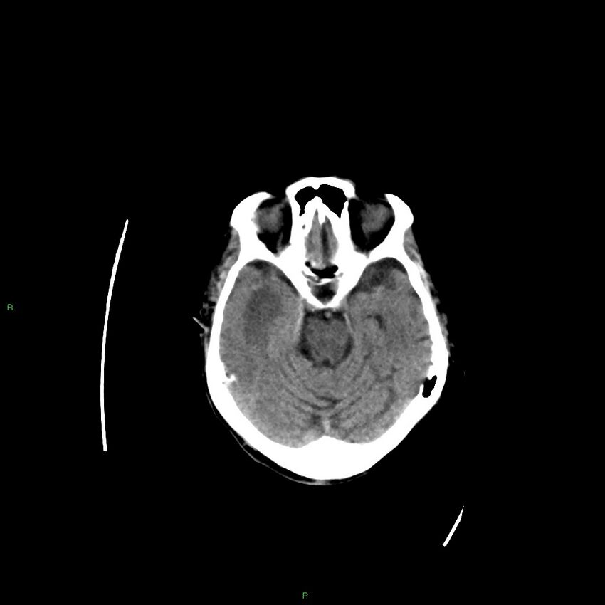 Basal ganglia hemorrhage (Radiopaedia 58350-65473 Axial non-contrast 30).jpg