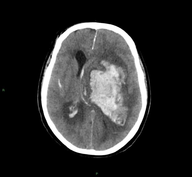 File:Basal ganglia hemorrhage (Radiopaedia 58775-66008 Axial non-contrast 31).jpg