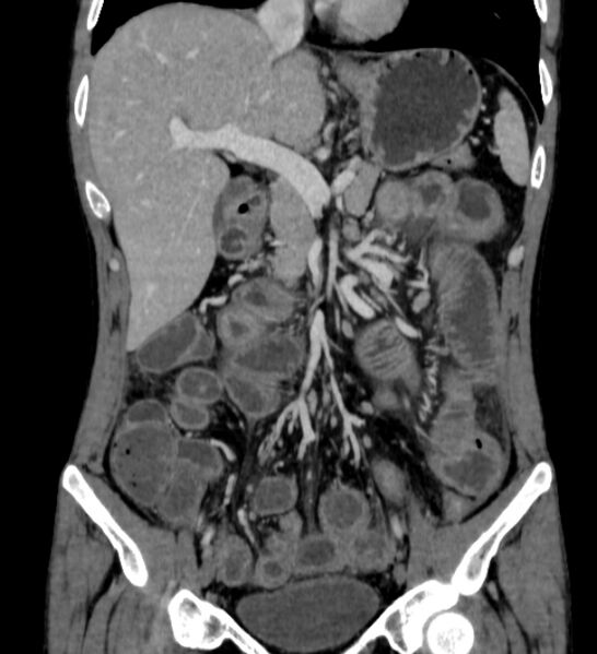 File:Behçet's disease- abdominal vasculitis (Radiopaedia 55955-62570 B 22).jpg