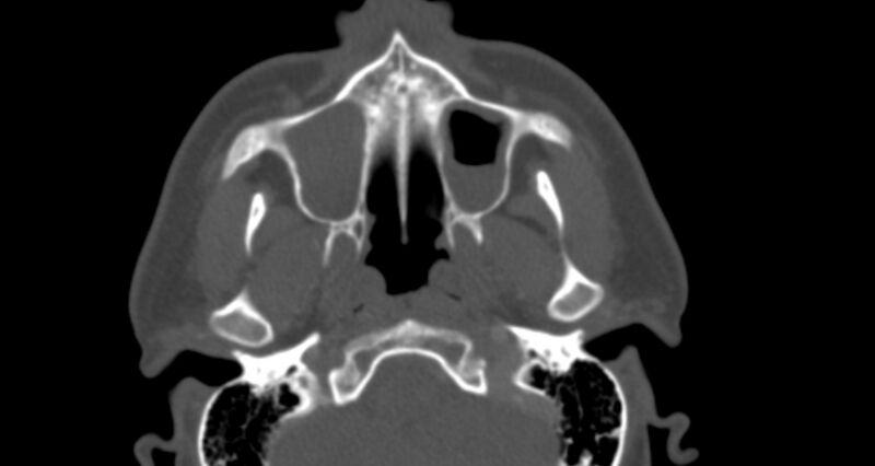 File:Benign mixed salivary tumor of the parotid gland (Radiopaedia 35261-36792 Axial bone window 11).jpg