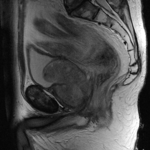 File:Benign prostatic hyperplasia (Radiopaedia 2701-6402 Sagittal T2 1).jpg