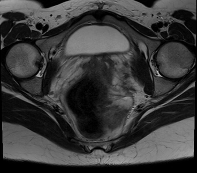 File:Bicornuate uterus (Radiopaedia 71214-81511 Axial T2 11).jpg