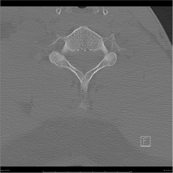 File:Bilateral cervical ribs (Radiopaedia 25868-26017 Axial bone window 38).jpg