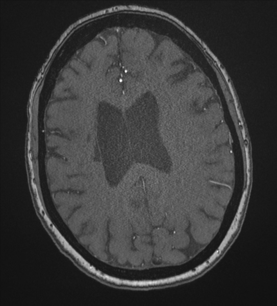 File:Bilateral fetal posterior communicating arteries (Radiopaedia 41286-44102 Axial MRA 149).png