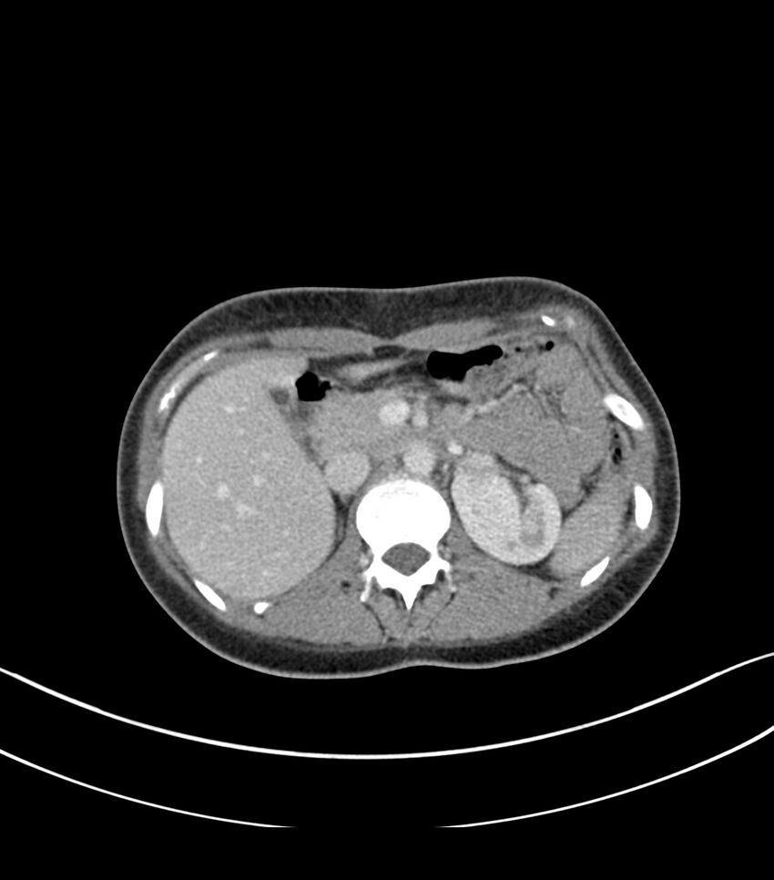 Bilateral kidney malrotation (Radiopaedia 72227-82749 A 12).jpg