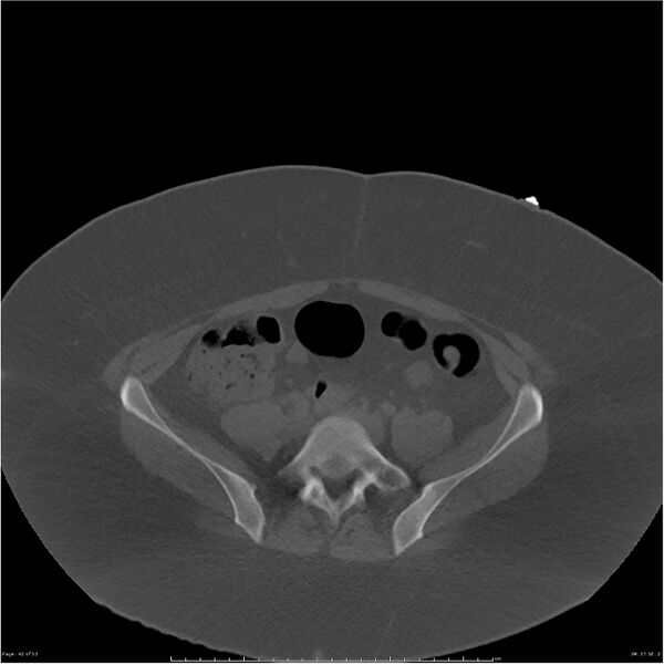 File:Bilateral lumbar ribs (Radiopaedia 25862-26010 bone window 42).jpg