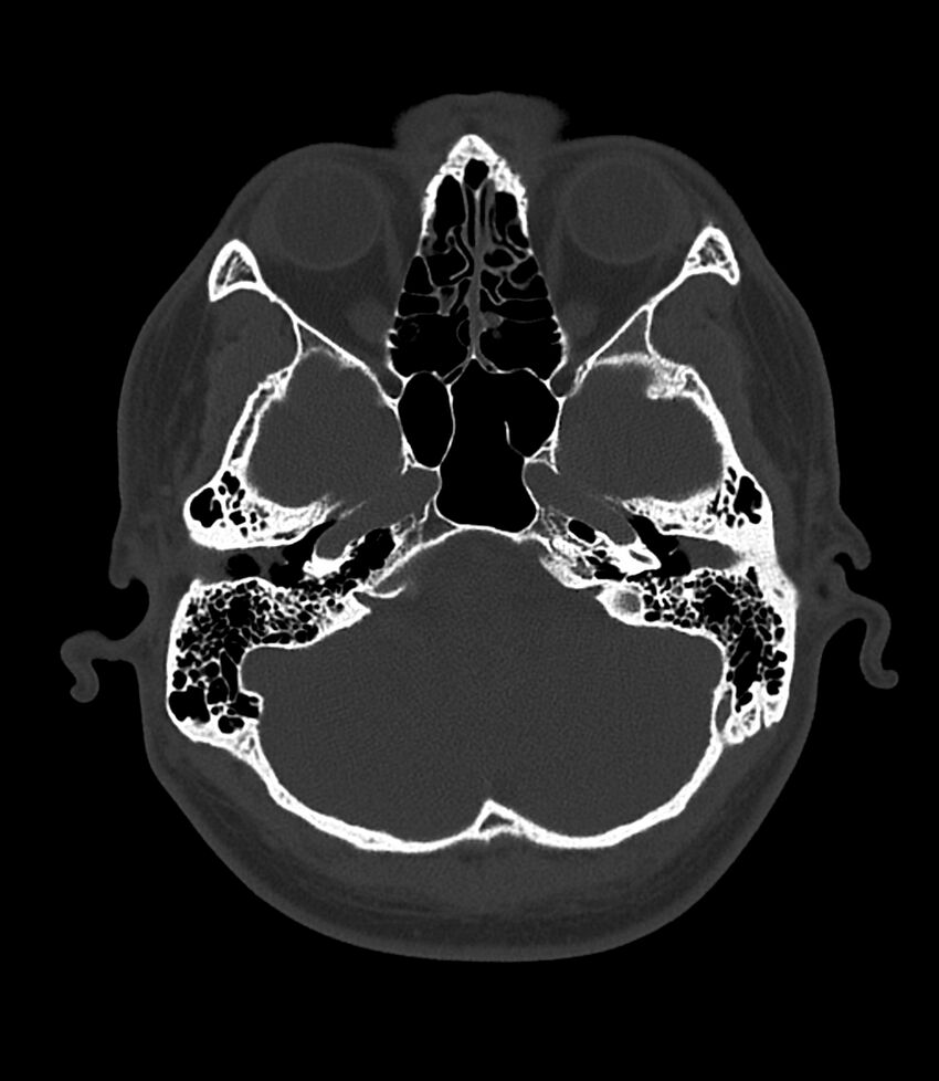 Bilateral medial canal fibrosis (Radiopaedia 85598-101344 Axial bone window 30).jpg
