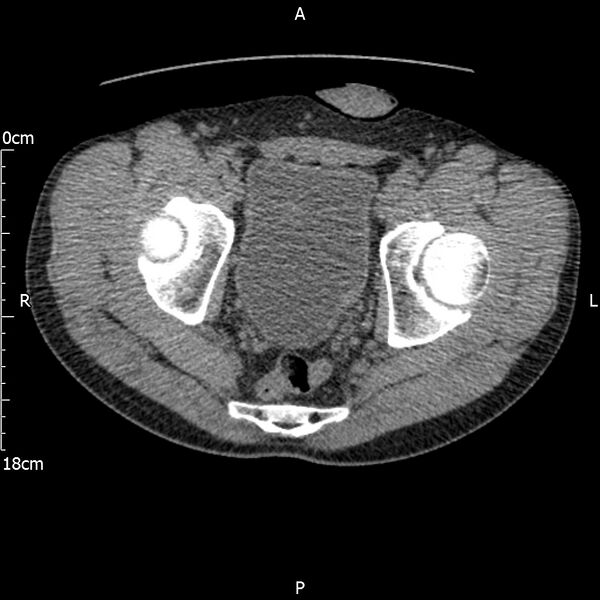 File:Bilateral medullary nephrocalcinosis with ureteric calculi (Radiopaedia 71269-81569 Axial non-contrast 121).jpg