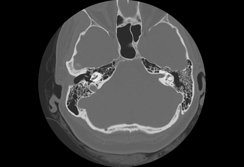 Bilateral otospongiosis (Radiopaedia 35447-36940 Axial bone window 29).jpg