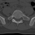 Bilateral pars defect (Radiopaedia 26691-26846 Axial bone window 60).jpg