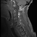 Bilateral perched facets with cord injury (Radiopaedia 45587-49714 Sagittal T1 11).jpg