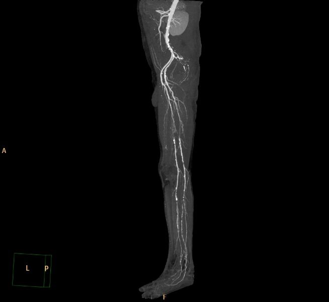 File:Bilateral superficial femoral arterial occlusion (Radiopaedia 25682-25857 3D MIP 19).jpg