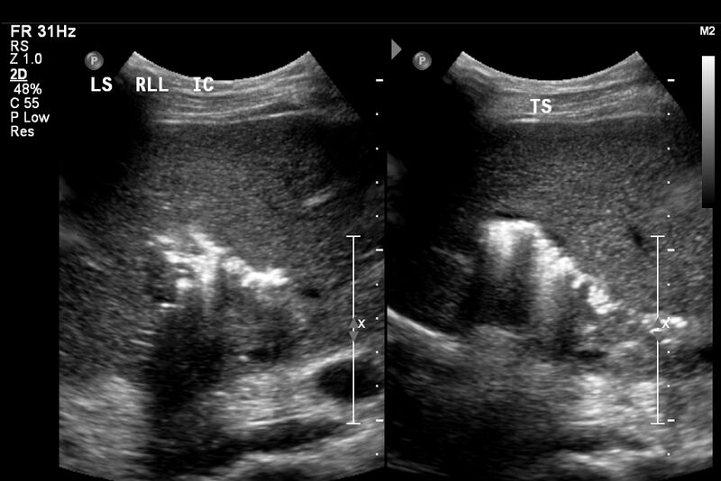 File:Biliary necrosis - liver transplant (Radiopaedia 21876-21843 A 5).jpg